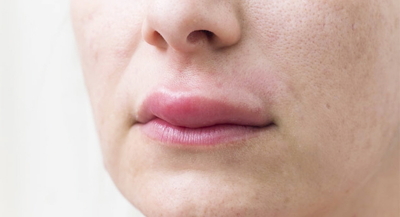 Hiểu đúng về chứng mề đay phù mạch