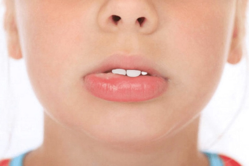 Hiểu đúng về chứng mề đay phù mạch