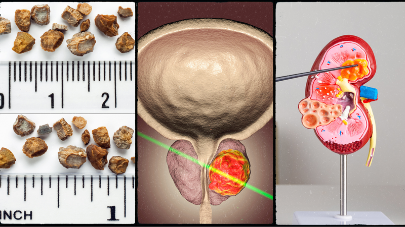 Hiểu rõ về những nguyên nhân suy thận để phòng tránh 2