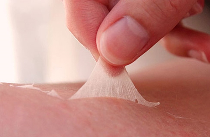 Hiểu rõ về tình trạng da bị cháy nắng 2