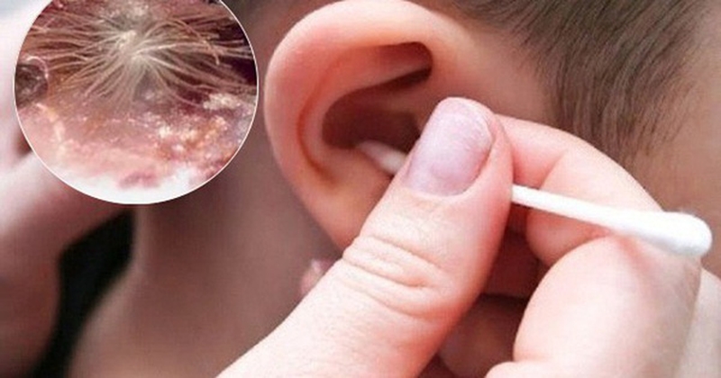 Hiểu về nấm ống tai ở trẻ em để phòng ngừa bệnh hiệu quả 2