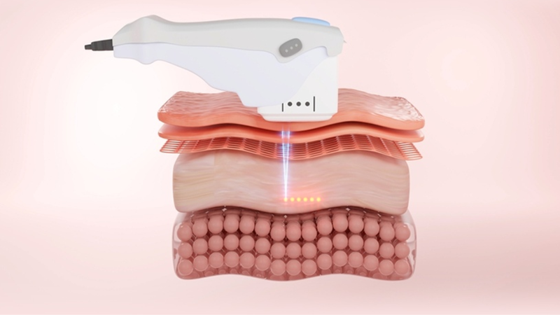 Hifu giá bao nhiêu và một liệu trình bao nhiêu lần? 2