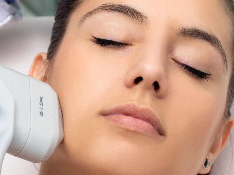 Hifu giá bao nhiêu và một liệu trình bao nhiêu lần? 3