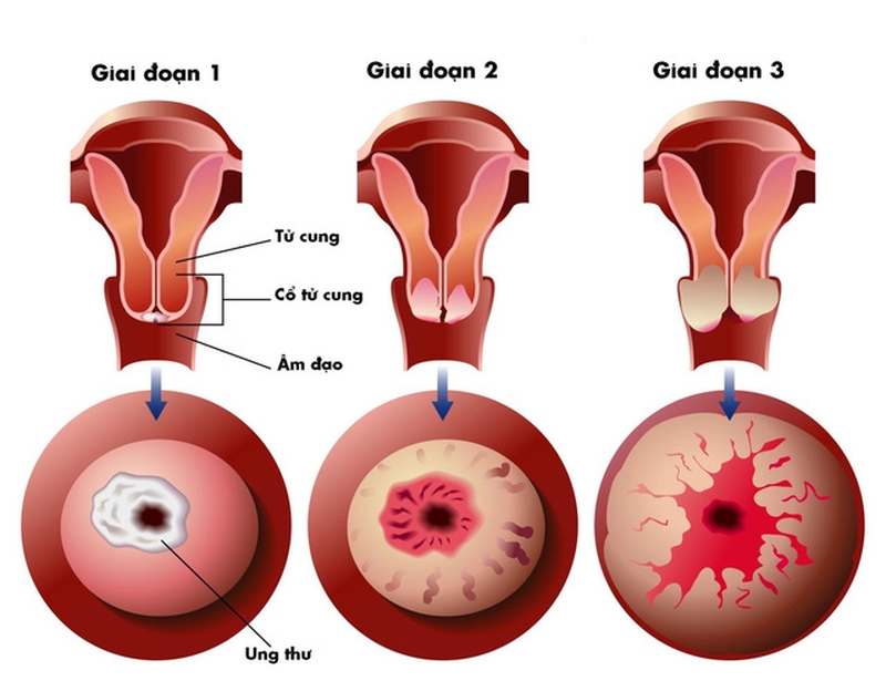 trieu-chung-ung-thu-co-tu-cung-giai-doan-cuoi-la-gi-2