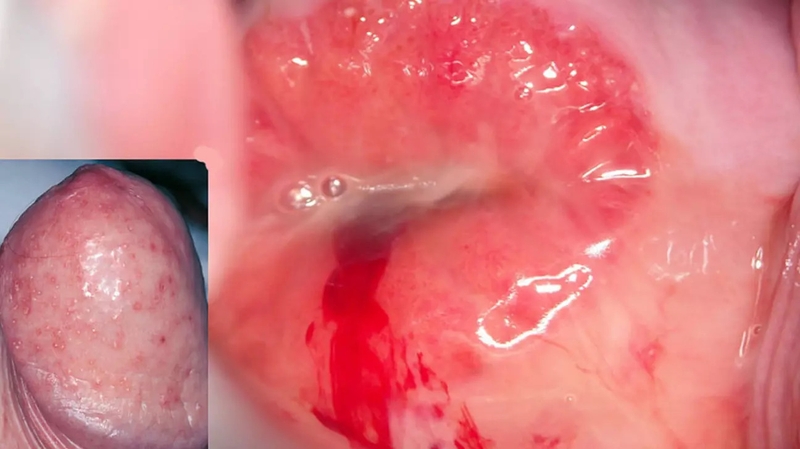 Hình ảnh bệnh Chlamydia: Những thông tin quan trọng cần biết 2