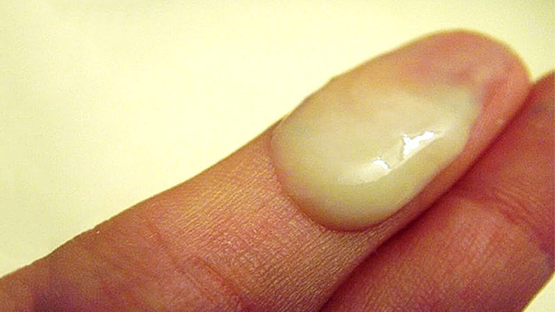 Hình ảnh bệnh Chlamydia: Những thông tin quan trọng cần biết 3