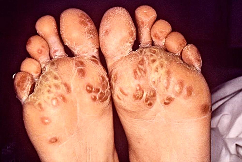 Hình ảnh bệnh Chlamydia: Những thông tin quan trọng cần biết 6