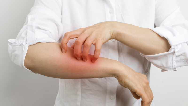 Bệnh ghẻ gây ngứa dữ dội về đêm