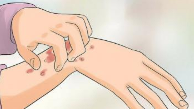 Khi bước sang giai đoạn 2, cơ thể người bệnh bắt đầu nổi những nốt ban rộng