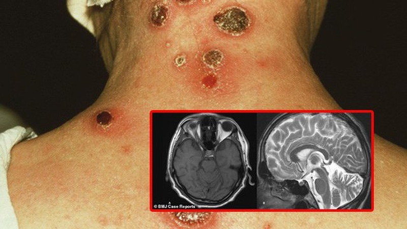 Ở giai đoạn cuối, giang mai gây ra những biến chứng nguy hiểm cho cơ thể người bệnh