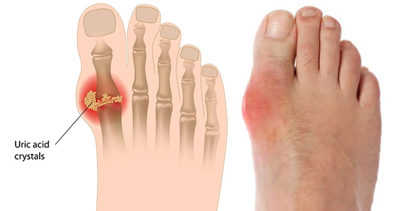 Hình ảnh bệnh gout và cách phòng tránh bệnh gout