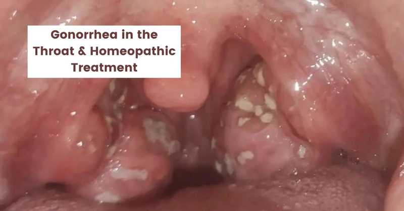 Hình ảnh bệnh lậu: Dấu hiệu nhận biết và các biến chứng khác 4