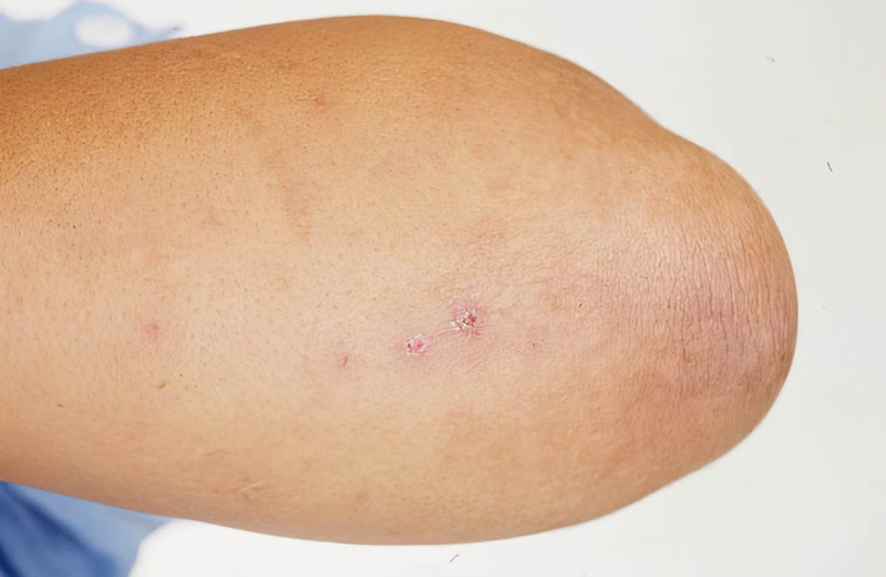 Hình ảnh bệnh lậu: Dấu hiệu nhận biết và các biến chứng khác 6