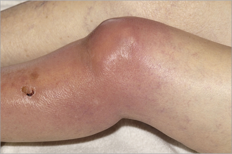 Hình ảnh bệnh lậu: Dấu hiệu nhận biết và các biến chứng khác 7