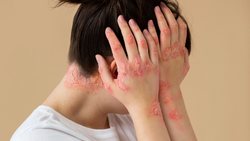 Hình ảnh bệnh lupus ban đỏ với các vết loét, mảng đỏ