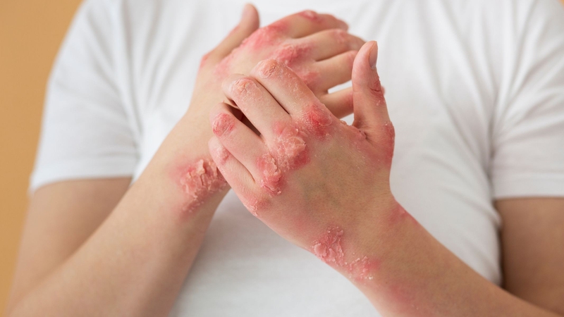 Ngoài các tổn thương ngoài da, lupus ban đỏ còn có thể gây viêm và sưng đau các khớp