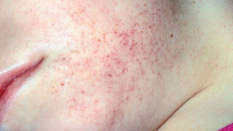 Một trong những dấu hiệu đặc trưng nhất của lupus ban đỏ là phát ban hai bên má