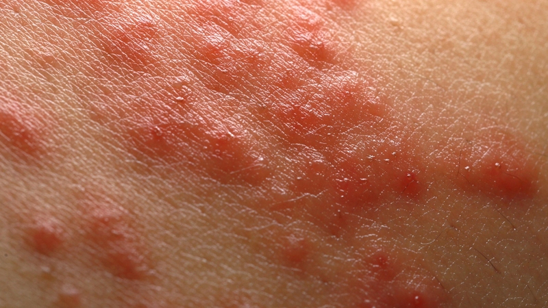 Hình ảnh bệnh nấm tổ đỉa từng loại dễ nhận biết và điều trị 1