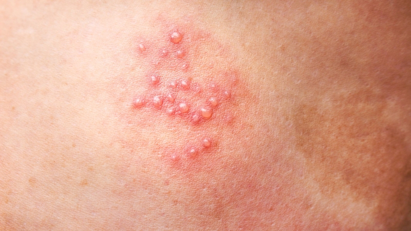 Hình ảnh bệnh nấm tổ đỉa từng loại dễ nhận biết và điều trị 2