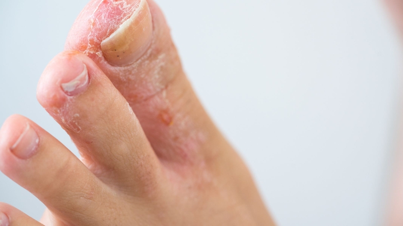 Hình ảnh bệnh nấm tổ đỉa từng loại dễ nhận biết và điều trị 3