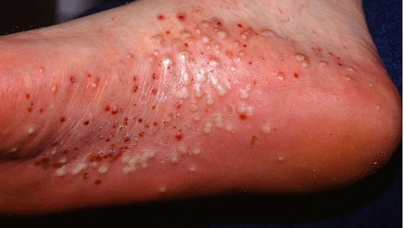 Hình ảnh bệnh nấm tổ đỉa từng loại dễ nhận biết và điều trị 4