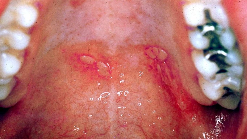 Hình ảnh bệnh tay chân miệng cấp độ 2&nbsp;cần được nhận diện sớm