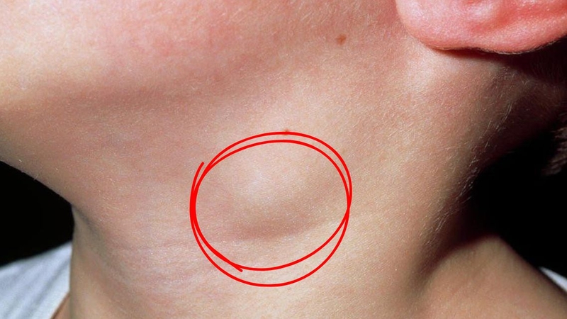 Hình ảnh sưng hạch bạch huyết ở trẻ tay chân miệng độ 2