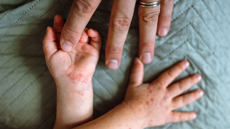 Hình ảnh và các dấu hiệu bất thường ở trẻ đều cần được theo dõi sát sao