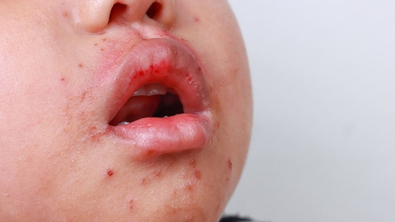 Trẻ bị tay chân miệng cấp độ 3 có thể gặp triệu chứng ở mức độ khác nhau