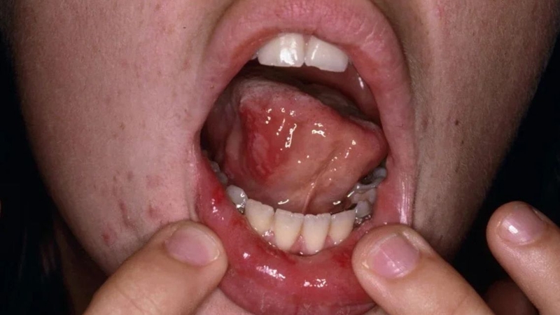 Cần đưa trẻ đến viện ngay khi thấy&nbsp;hình ảnh bệnh tay chân miệng cấp độ 3