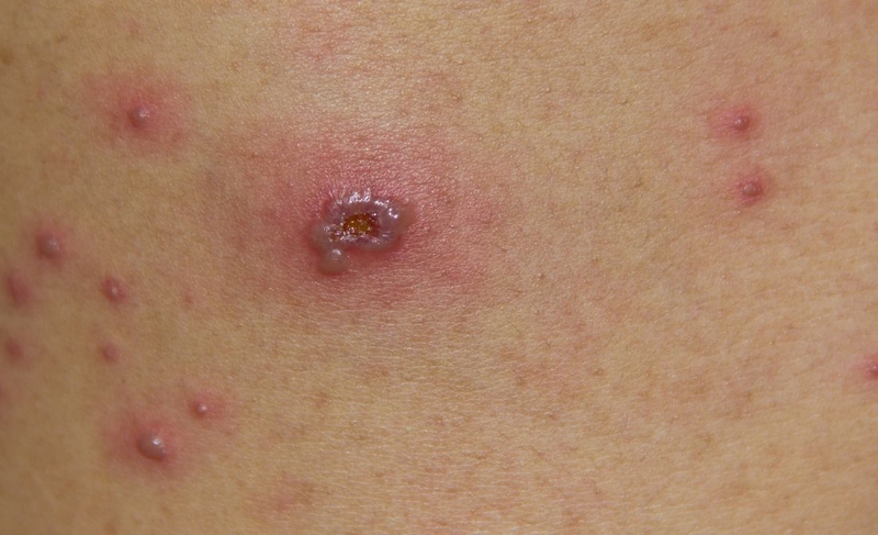 Hình ảnh bệnh thủy đậu ở người lớn thế nào? Nhận biết để điều trị sớm 1