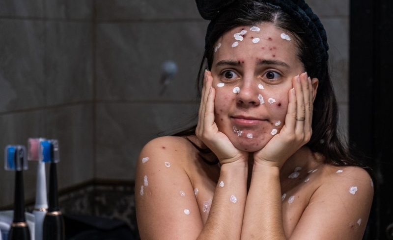 Hình ảnh bệnh thủy đậu ở người lớn thế nào? Nhận biết để điều trị sớm 3