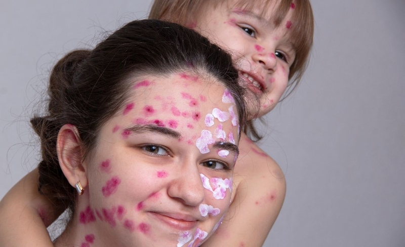 Hình ảnh bệnh thủy đậu ở người lớn thế nào? Nhận biết để điều trị sớm 4