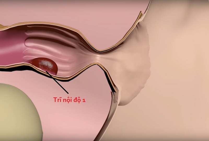 Cách dùng cây cỏ xước chữa bệnh trĩ an toàn và hiệu quả 1