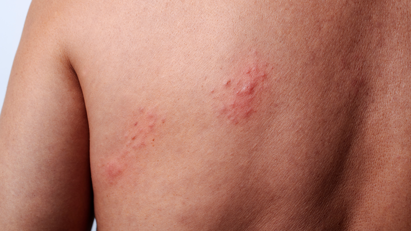 Hình ảnh bệnh zona thần kinh ở giai đoạn khởi phát