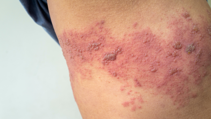 Dấu hiệu của bệnh zona thần kinh ở giai đoạn phát ban là điển hình và dễ nhận biết