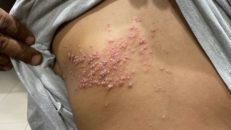 Hình ảnh minh họa zona thần kinh ở lưng