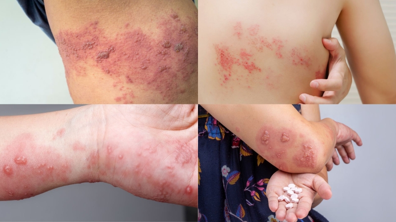 Hình ảnh bị giời leo qua các giai đoạn của bệnh 1