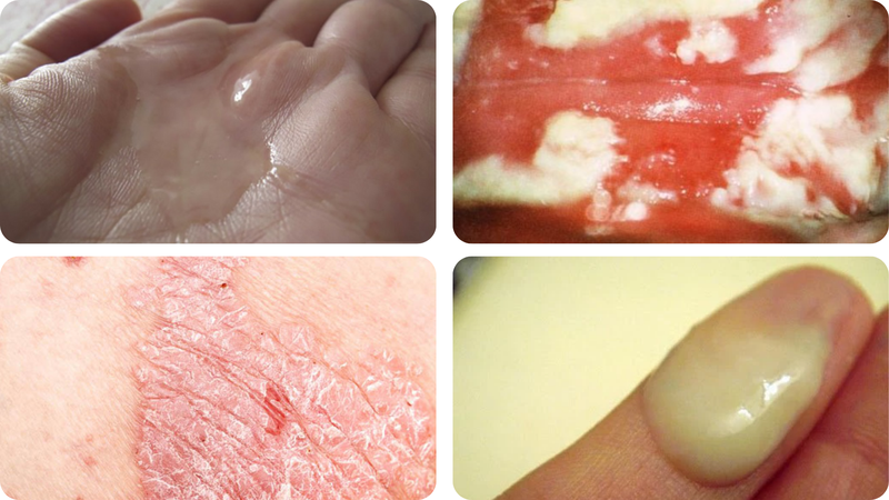 Hình ảnh bị nấm ở vùng kín - Nhận biết và hướng xử lý hiệu quả 1