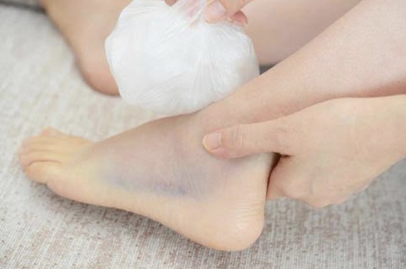 Hình ảnh bong gân bàn chân chi tiết nhất và cách điều trị 1