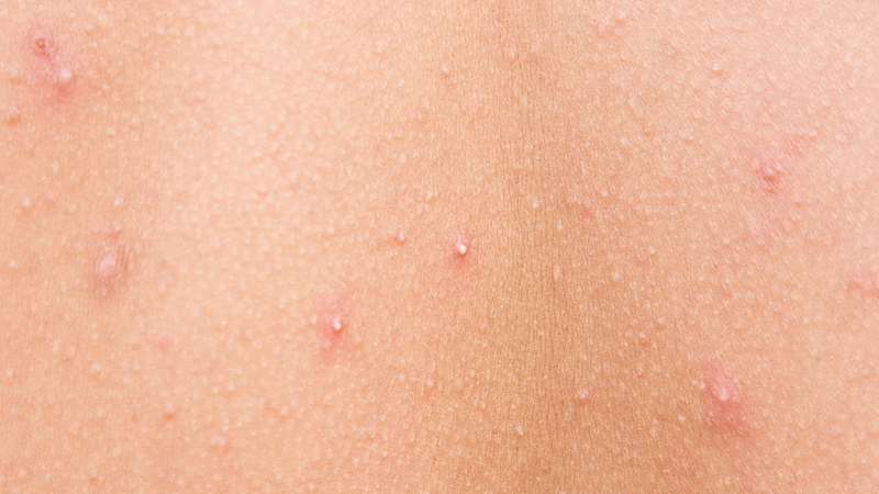 Hình ảnh các loại mụn khác nhau và cách điều trị hiệu quả 1