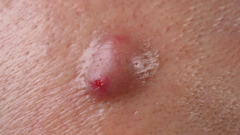 Hình ảnh các loại mụn khác nhau và cách điều trị hiệu quả 4