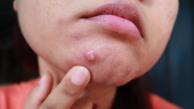 Hình ảnh các loại mụn khác nhau và cách điều trị hiệu quả 5