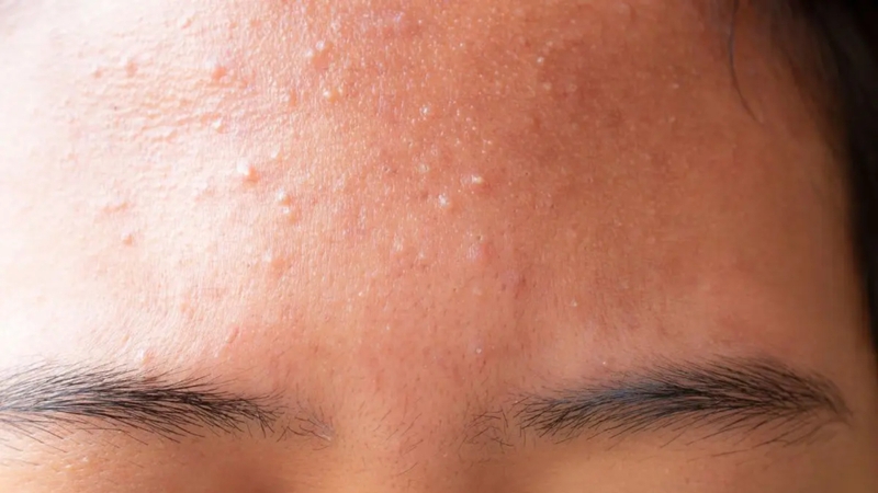 Hình ảnh các loại mụn khác nhau và cách điều trị hiệu quả 6