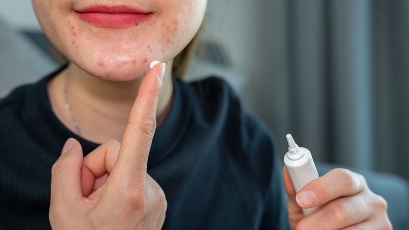 Hình ảnh các loại mụn khác nhau và cách điều trị hiệu quả 7