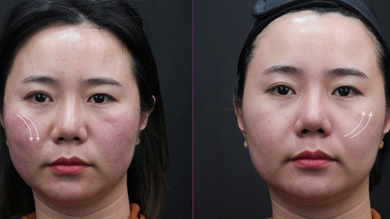 Hình ảnh căng da mặt bằng chỉ cho thấy hiệu quả chỉ sau một liệu trình