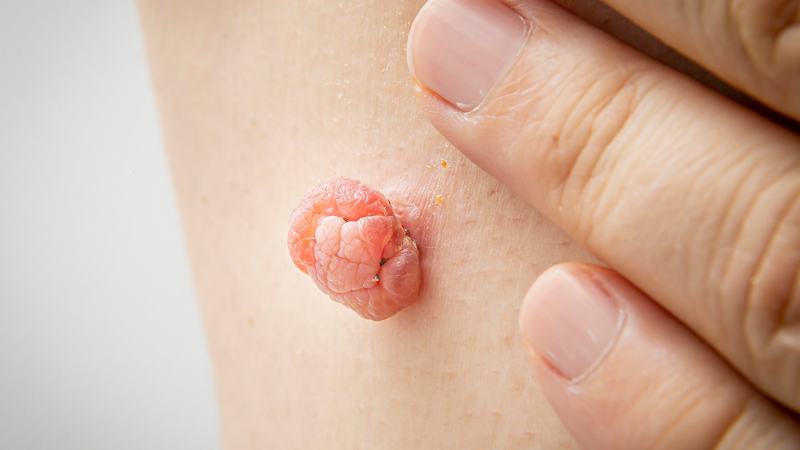 Hình ảnh cục thịt thừa ở vùng kín có thể gây mất thẩm mĩ