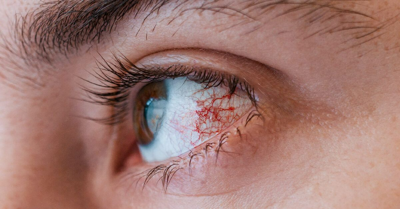 Hình ảnh bệnh đau mắt đỏ qua các giai đoạn3