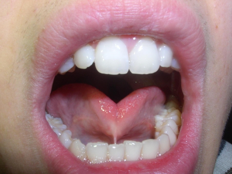 hinh-anh-dinh-thang-luoi-o-tre-em-la-gi-co-nguy-hiem-khong 1.jpg