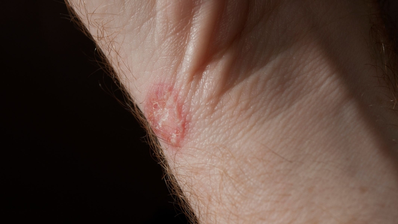 Hình ảnh lác đồng tiền đặc trưng bởi các tổn thương da hình tròn hoặc bầu dục, viền rõ và có xu hướng lan rộng nếu không được điều trị